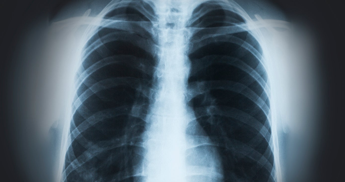 X-ray of pair of lungs