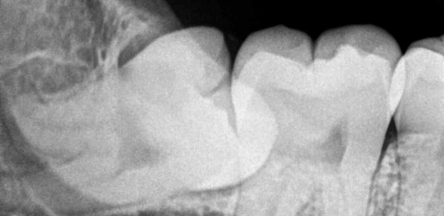 An Xray of an impacted wisdom tooth