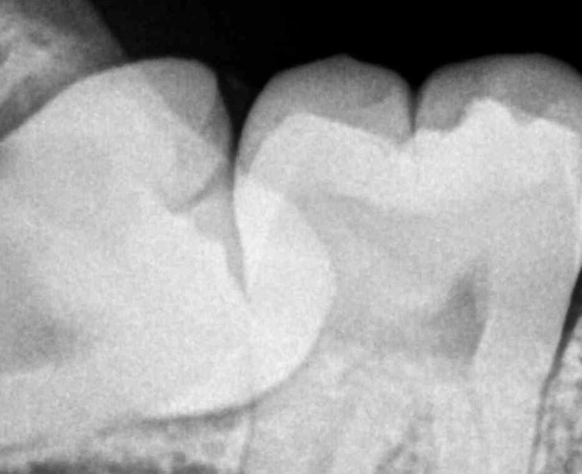 An Xray of an impacted wisdom tooth
